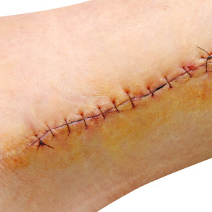 Laceration/Cut/Stitches